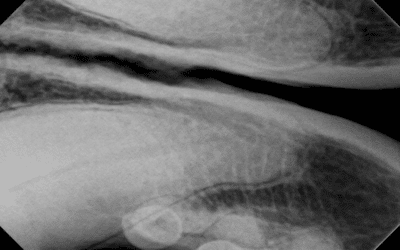 Fractured Teeth and Endodontics